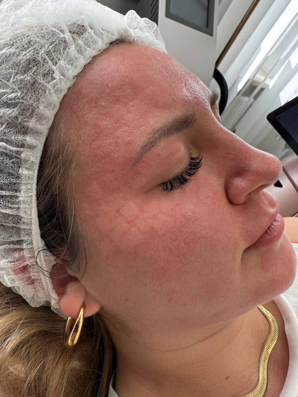 Delikatnie zaróżowiona skóra tuż po zabiegu radiofrekwencji mikroigłowej w Kosmet Beauty (Koszalin)