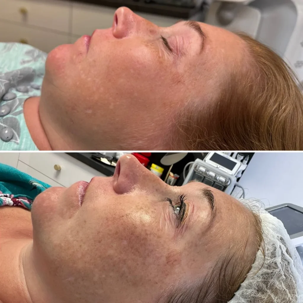 Efekty po zabiegu Redukcja przebarwień laserem IPL w gabinecie kosmetologicznym Kosmet Beauty w Koszalinie