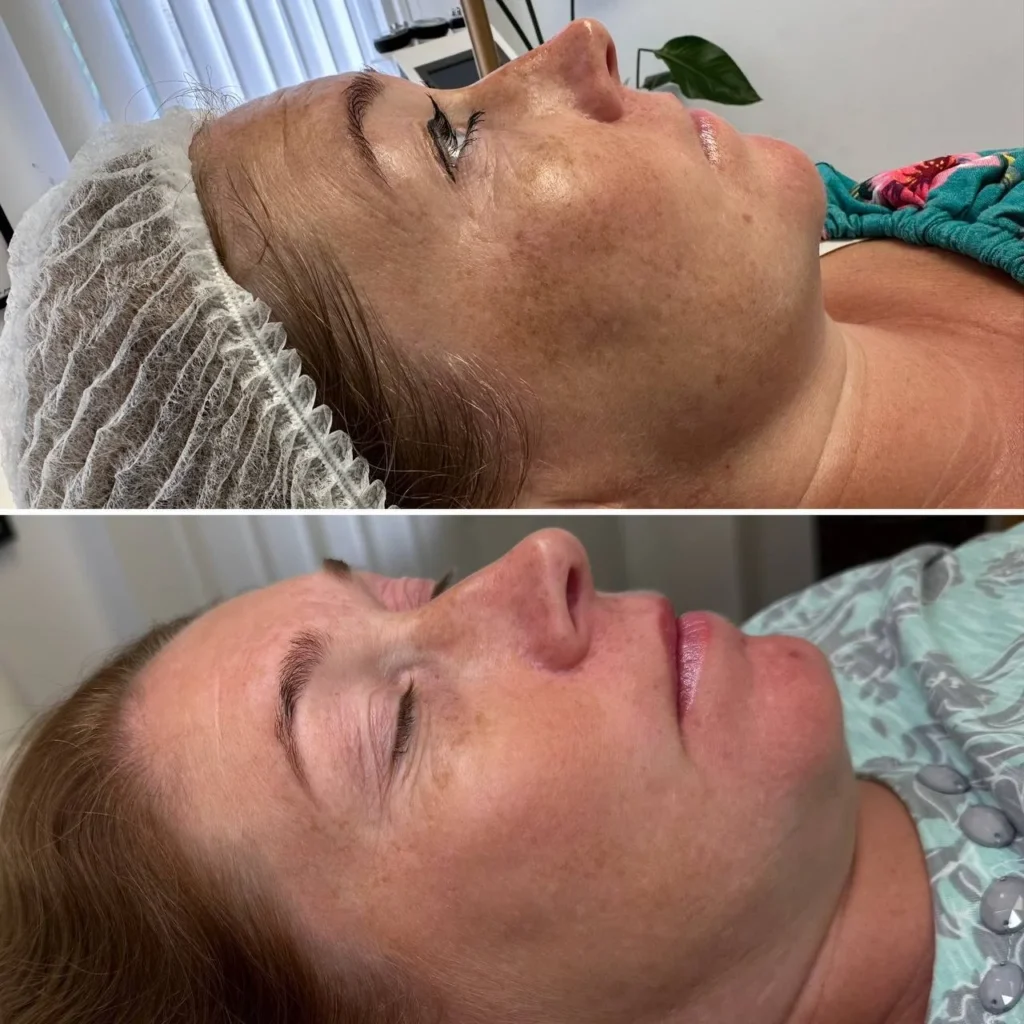 Efekty po zabiegu Redukcja przebarwień laserem IPL w gabinecie kosmetologicznym Kosmet Beauty w Koszalinie