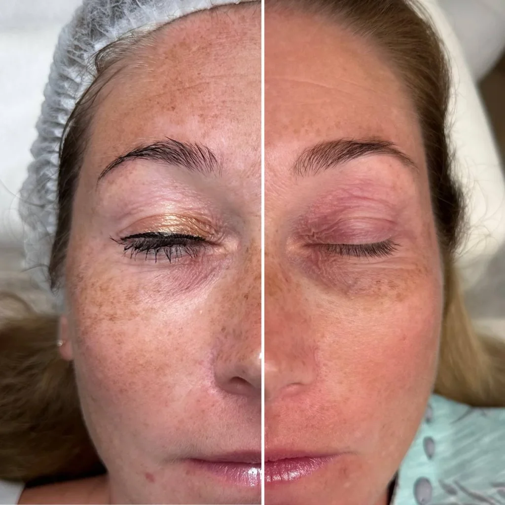 Efekty po zabiegu Redukcja przebarwień laserem IPL w gabinecie kosmetologicznym Kosmet Beauty w Koszalinie