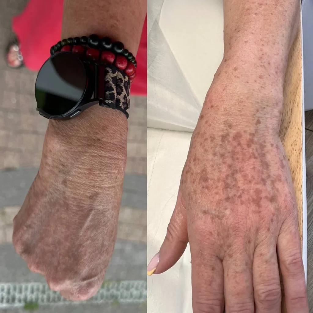 Efekty po zabiegu Redukcja przebarwień laserem IPL w gabinecie kosmetologicznym Kosmet Beauty w Koszalinie