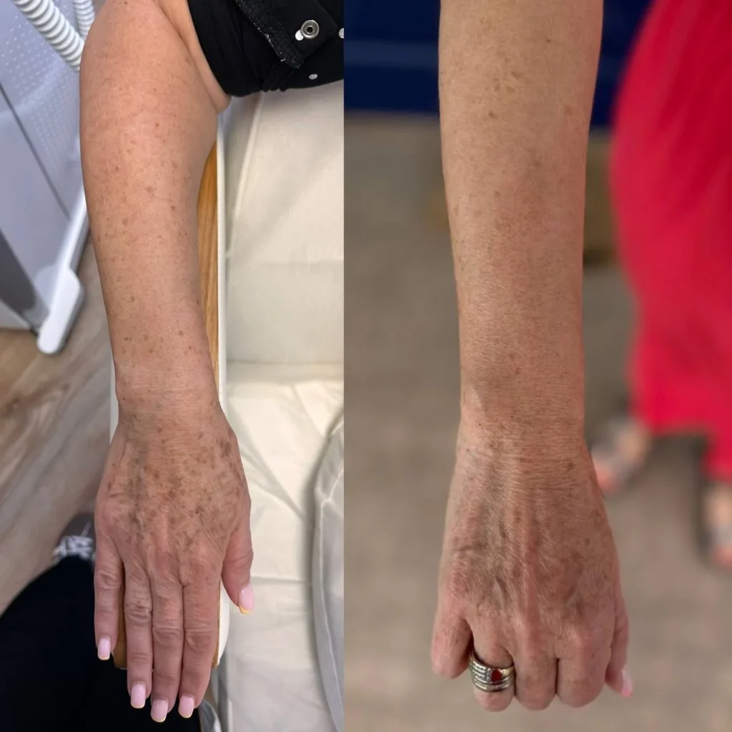 Efekty po zabiegu Redukcja przebarwień laserem IPL w gabinecie kosmetologicznym Kosmet Beauty w Koszalinie