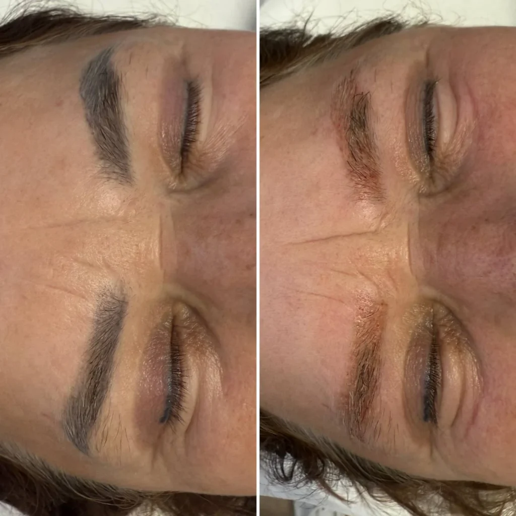 Efekty po zabiegu usuwania makijażu permanentnego w Kosmet Beauty w Koszalinie