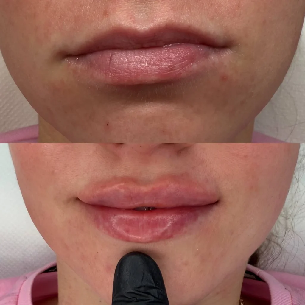 Efekty po zabiegu Powiększanie i Modelowanie ust w salonie kosmetologicznym Kosmet Beauty w Koszalinie