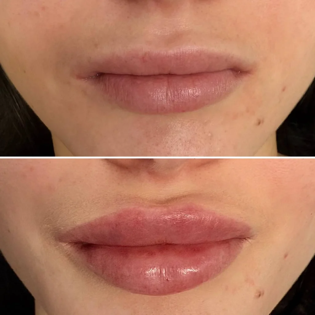 Efekty po zabiegu Powiększanie i Modelowanie ust w salonie kosmetologicznym Kosmet Beauty w Koszalinie