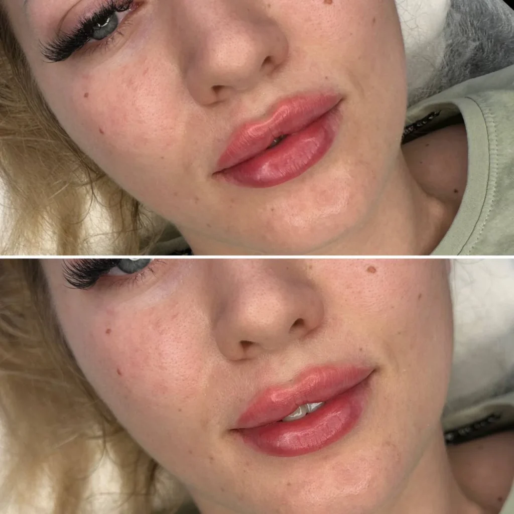 Efekty po zabiegu Powiększanie i Modelowanie ust w salonie kosmetologicznym Kosmet Beauty w Koszalinie