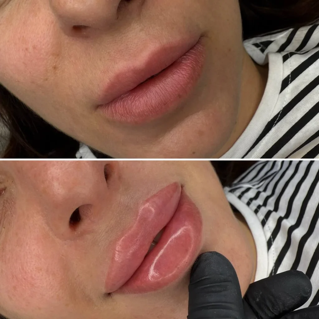 Efekty po zabiegu Powiększanie i Modelowanie ust w salonie kosmetologicznym Kosmet Beauty w Koszalinie