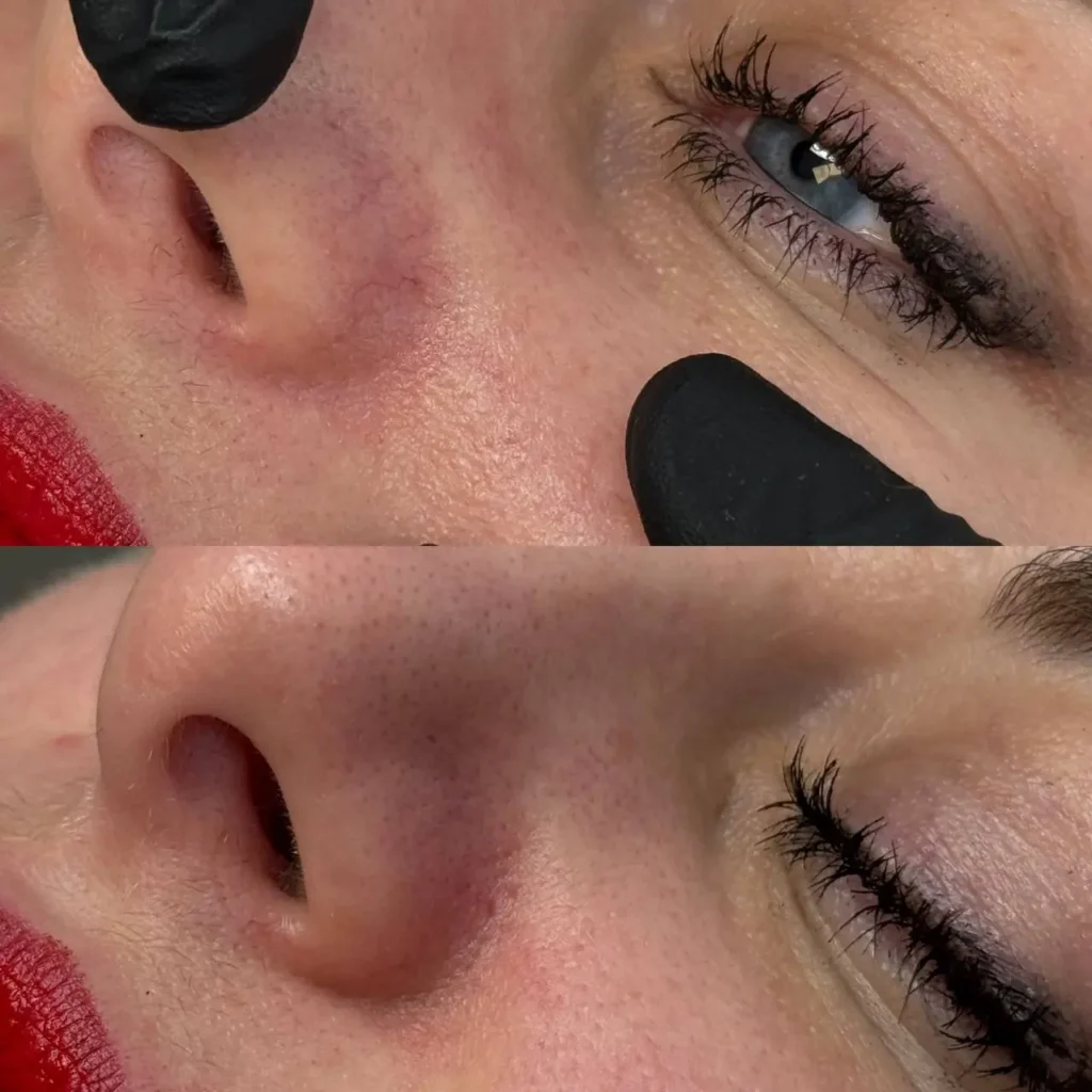 Zamykanie naczynek na nosie metodą elektrokoagulacji - efekty przed i po