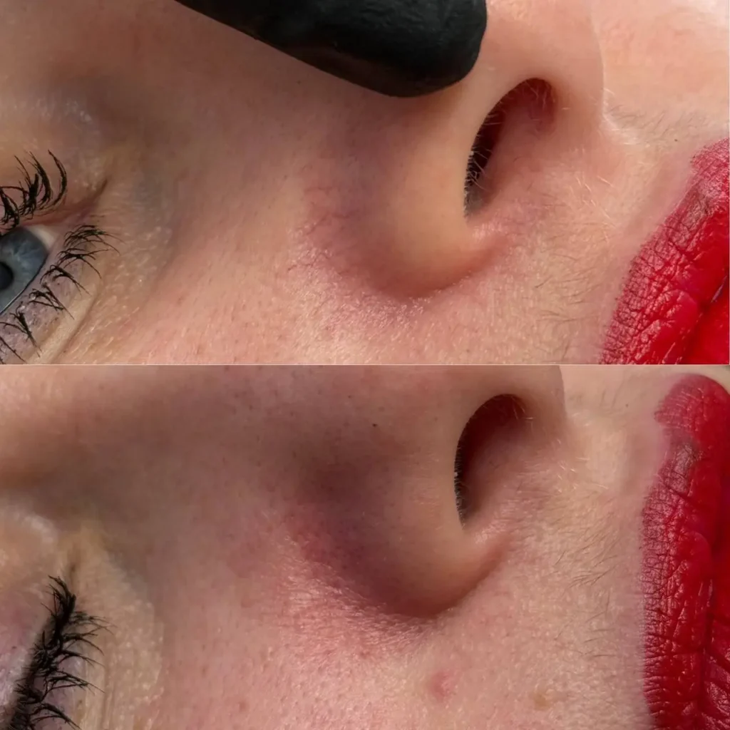 Nos przed i po zabiegu elektrokoagulacji - widoczna redukcja popękanych naczynek