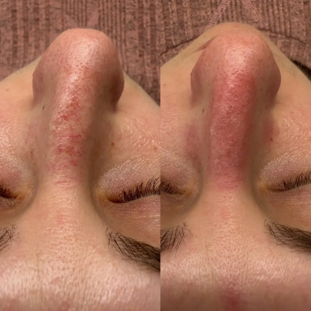 Gładki nos bez siateczki naczynek po zabiegu elektrokoagulacji