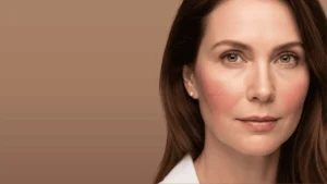 Popękane naczynka na policzkach - wskazanie do zabiegu elektrokoagulacji