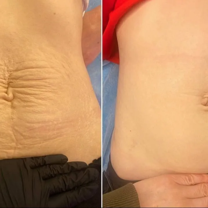 Wynik po zabiegu Mikronakłuwanie (Microneedling) w Kozalinie