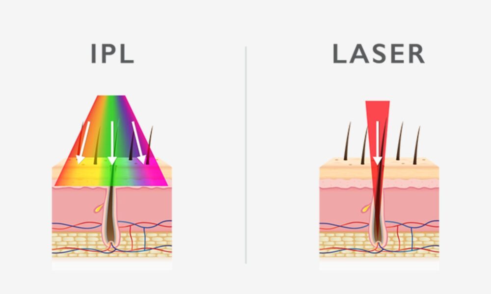 Laser diodowy czy IPL — czym się różnią i co wybrać?