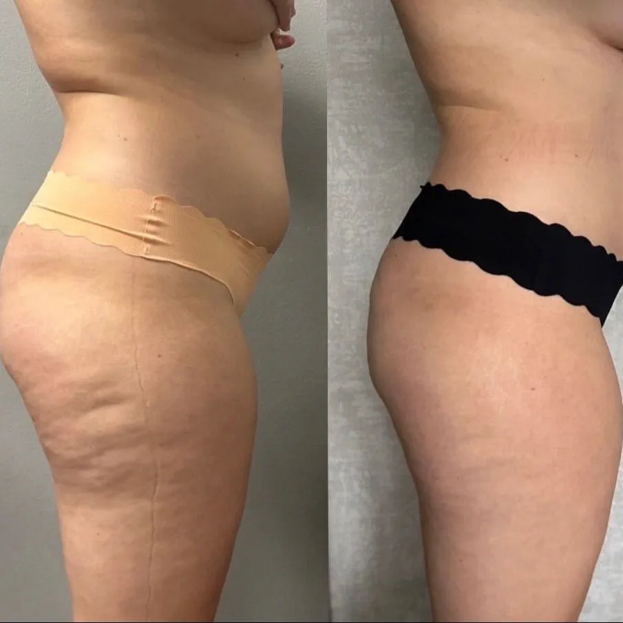 Lipoplastyka manualna