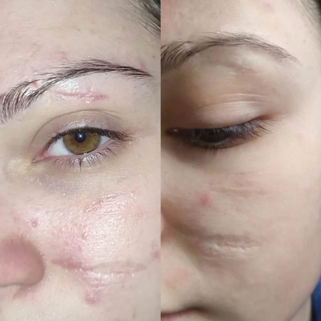 Wynik po zabiegu Mikronakłuwanie (Microneedling) w Kozalinie