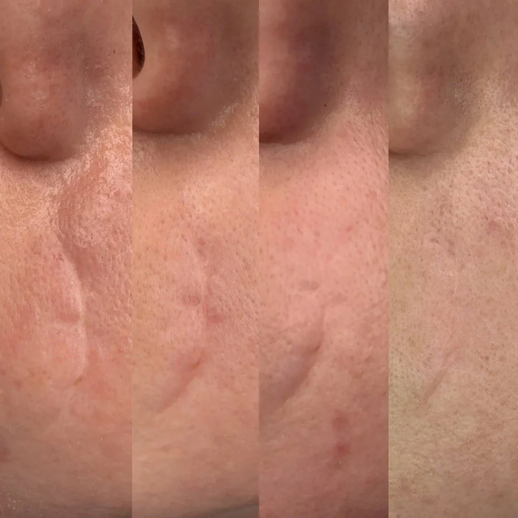 Wynik po zabiegu Mikronakłuwanie (Microneedling) w Kozalinie