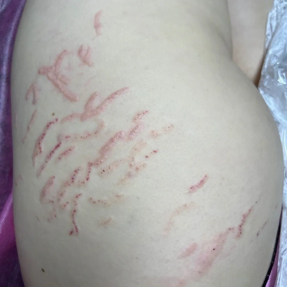 Wynik po zabiegu Mikronakłuwanie (Microneedling) w Kozalinie